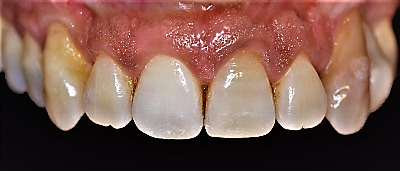 استفاده از لیزر در دندانپزشکی در مطب دکتر زهرا ظهری متخصص جراحی لثه و ایمپلنت و لیزر در دندانپزشکی